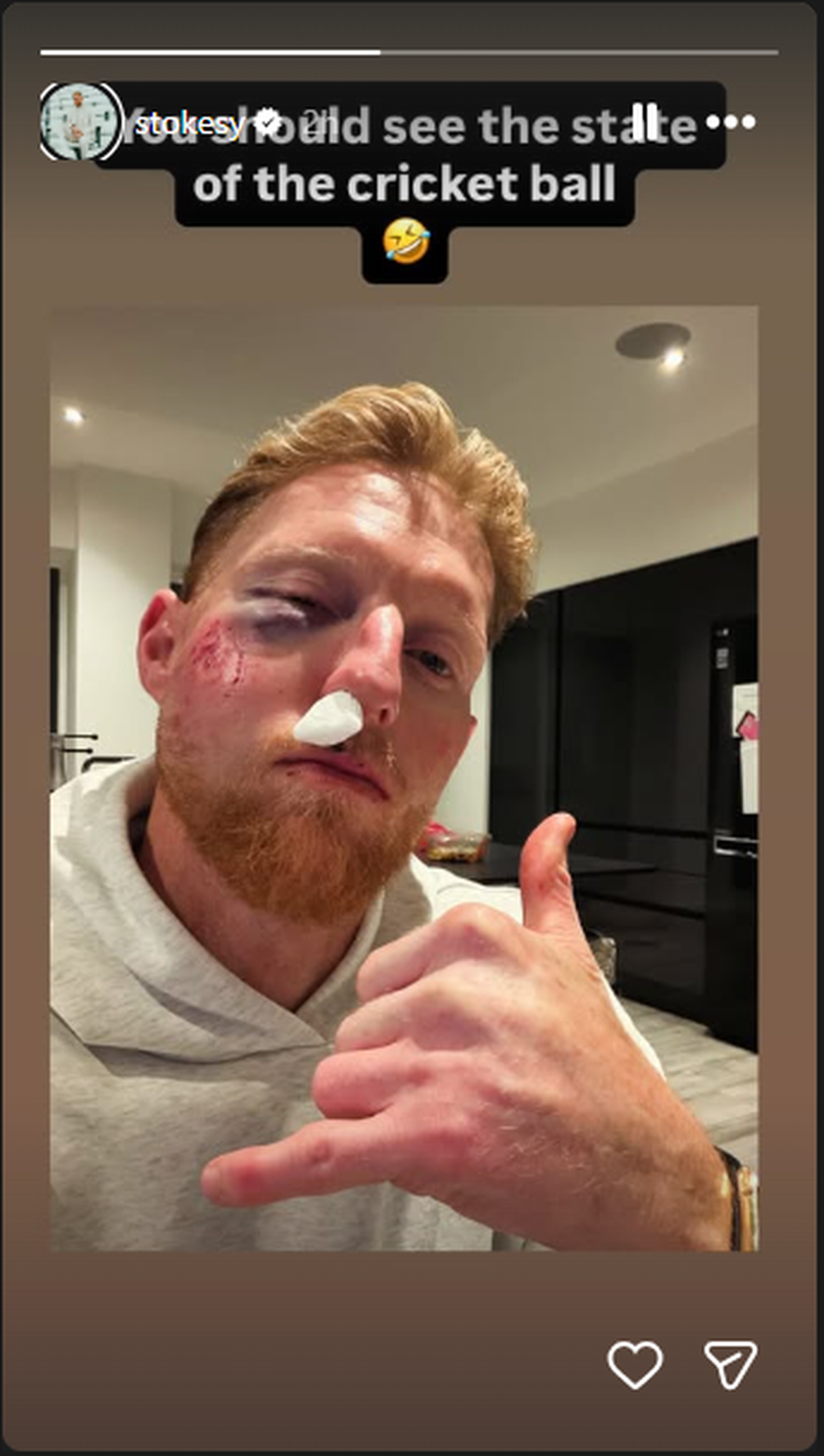 Stokes posted a picture showing his right eye heavily swollen and bruised, a graze on his cheek and lip, and a bandage stuffed in his nose.