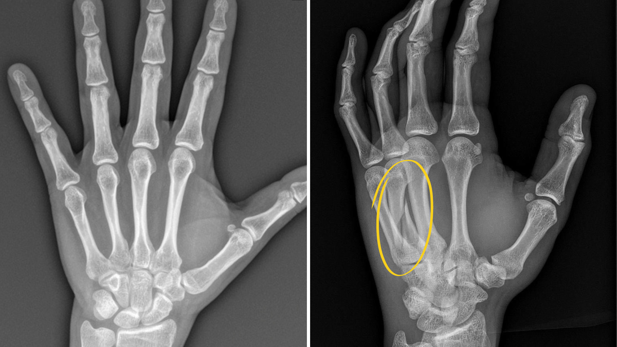 An xray of a regular hand. Right- Neeraj’s hand with his fracture in the metacarpal